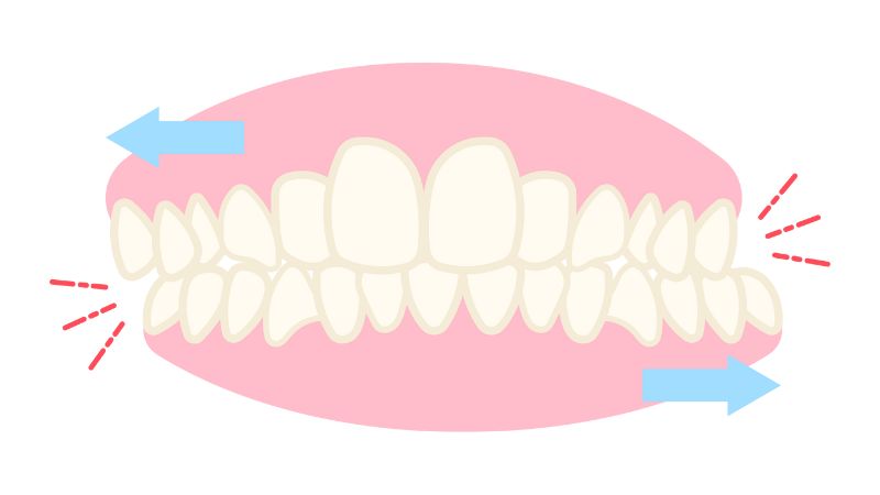 食いしばり 防止 トレーニング